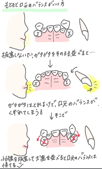 八重歯を抜かないで 八重歯の治療について お知らせ ブログ 江戸川区一之江の歯並び専門のステラ矯正歯科