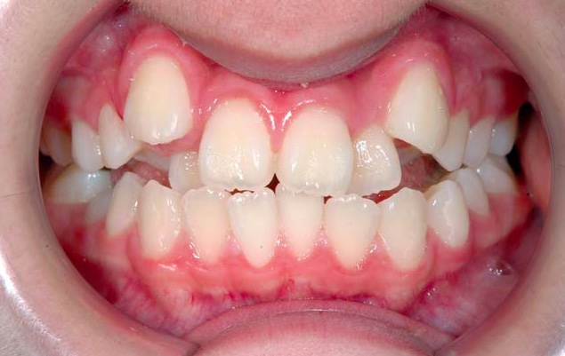 八重歯を抜かないで 八重歯の治療について お知らせ ブログ 江戸川区一之江の歯並び専門のステラ矯正歯科