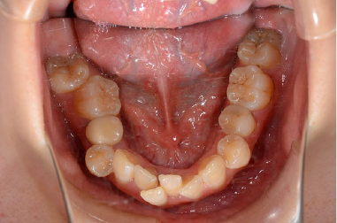 下の歯の写真