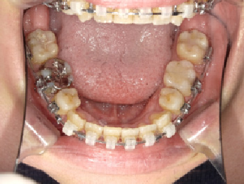 30代女性Bさん八重歯矯正治療12ヶ月目下