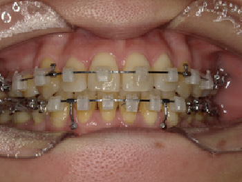 30代女性Bさん八重歯矯正治療12ヶ月目前