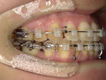 30代女性Bさん八重歯矯正治療12ヶ月目右