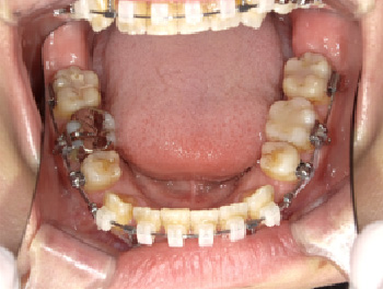 30代女性Bさん八重歯矯正治療7ヶ月目下