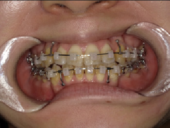 30代女性Bさん八重歯矯正治療7ヶ月目前