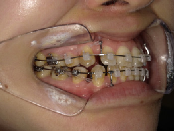 30代女性Bさん八重歯矯正治療7ヶ月目右