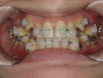 30代女性Bさん八重歯矯正治療初回前