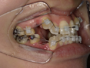 30代女性Bさん八重歯矯正治療初回右