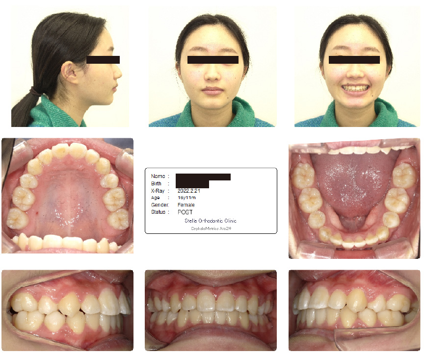 八重歯の矯正後女の子の口内写真