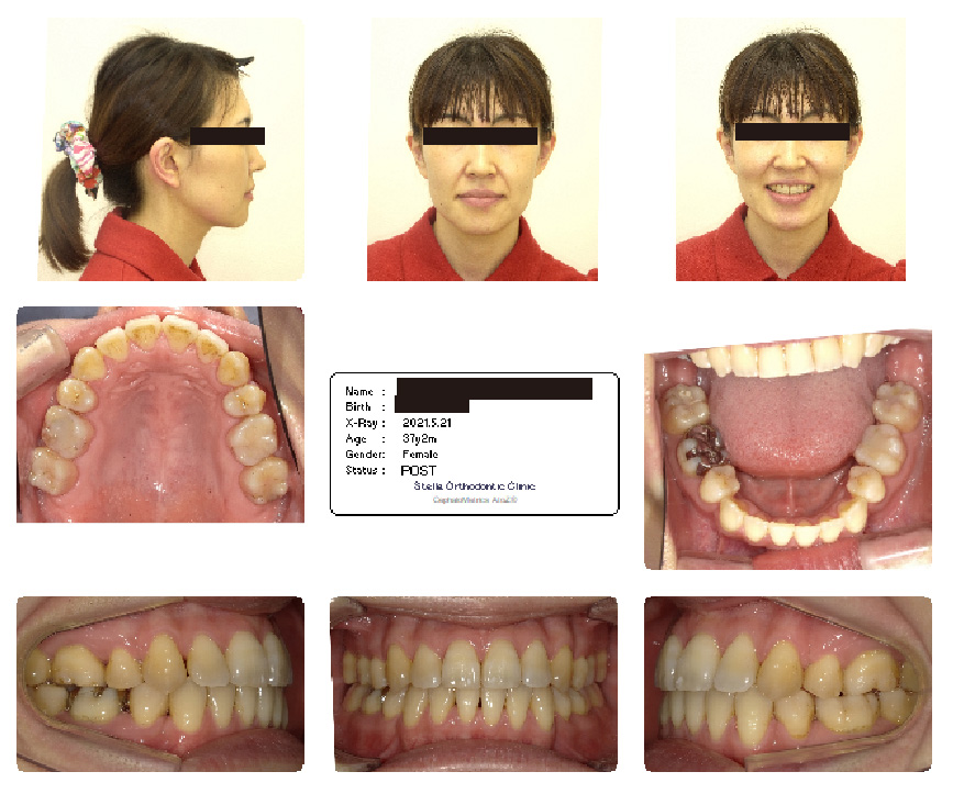 八重歯の矯正後の女性の口内写真