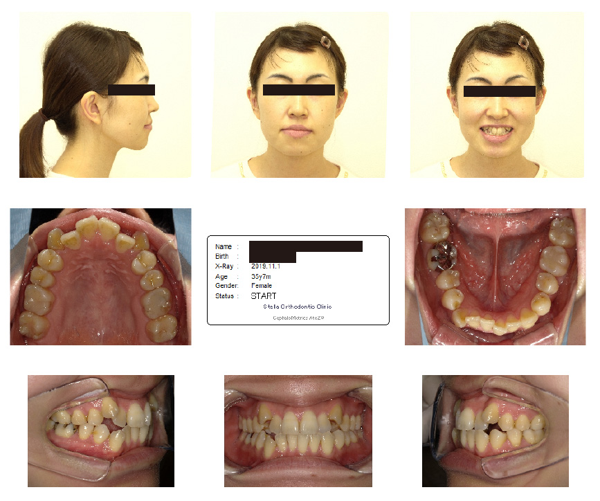 八重歯の女性の口内写真
