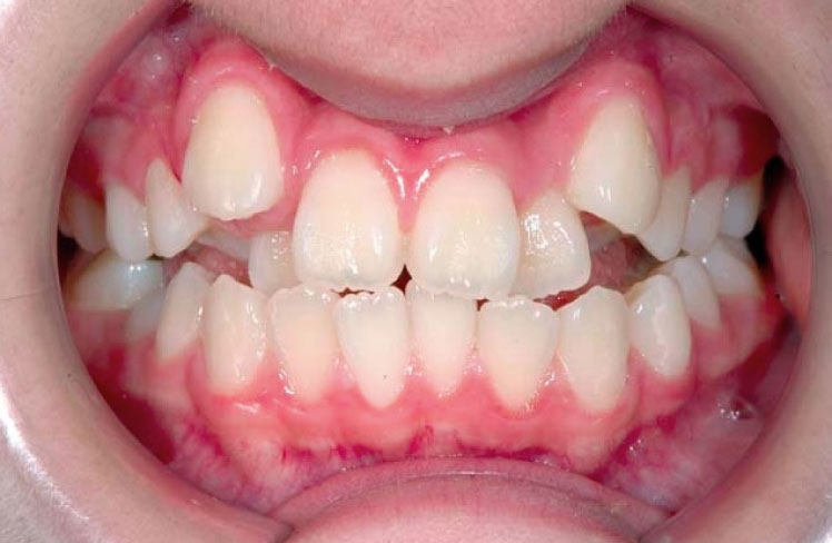 八重歯の人の口内写真