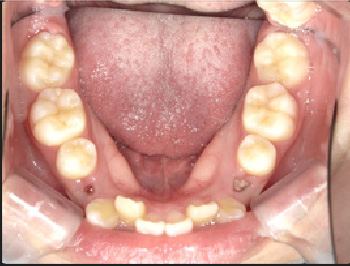中学3年生Aさん八重歯矯正治療3ヶ月目下