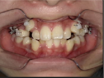 中学3年生Aさん八重歯矯正治療3ヶ月目前