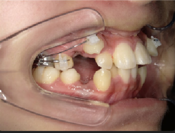 中学3年生Aさん八重歯矯正治療3ヶ月目右