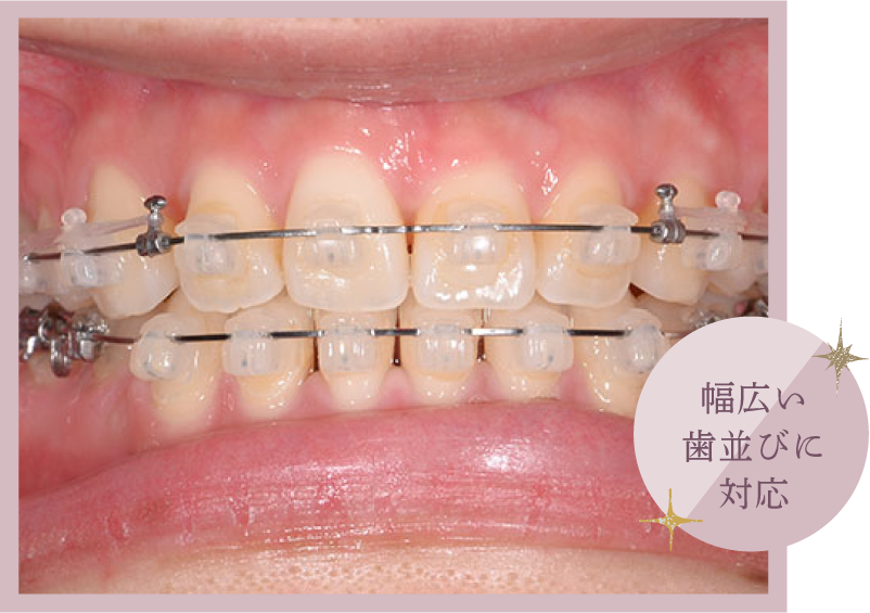 幅広い歯並びに対応