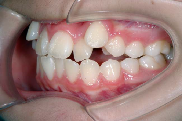 叢生の歯並び例・左