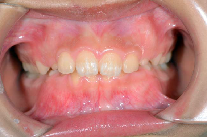過蓋咬合の歯並び例・正面