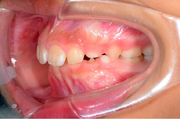 過蓋咬合の歯並び例・上
