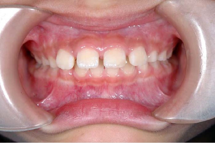 空隙歯列の歯並び例・正面