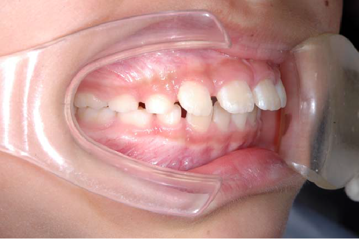 空隙歯列の歯並び例・上