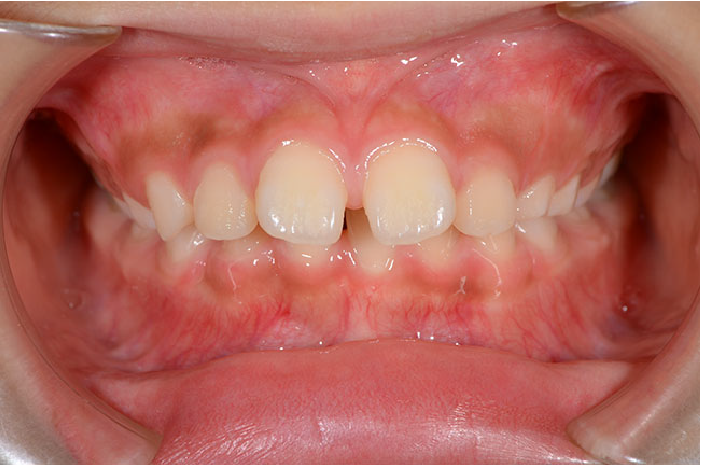 上顎前突の歯並び例・正面