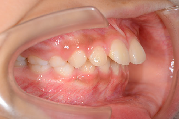 上顎前突の歯並び例・右