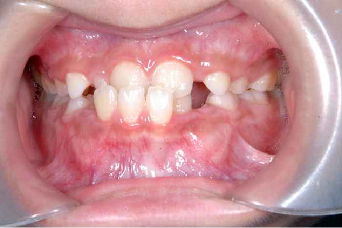 反対咬合、下顎前突の歯並び例・正面