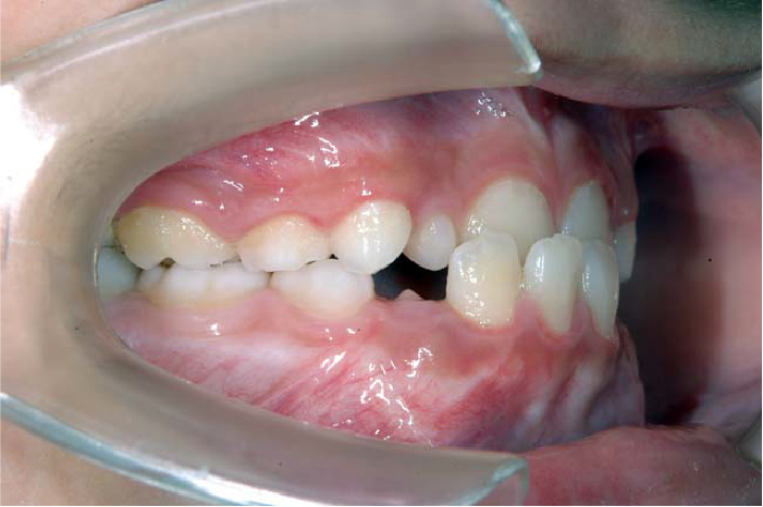 反対咬合、下顎前突の歯並び例・上