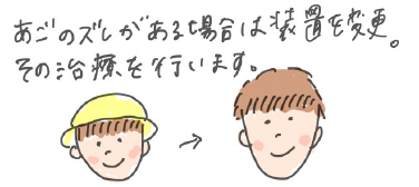 あごのズレがある場合は装置を変更