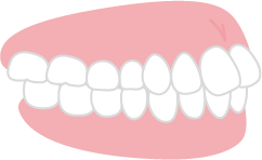 出っ歯の歯並びのイメージ