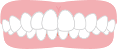 過蓋咬合(かがいこうごう)の歯並びのイメージ
