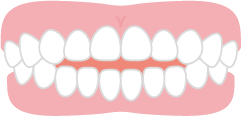 オープンバイトの歯並びのイメージ