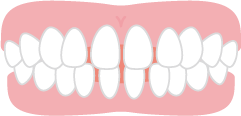 すきっ歯の歯並びのイメージ