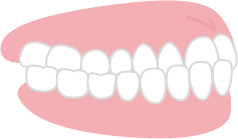 受け口の歯並びのイメージ