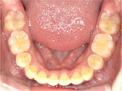 成人女性Aさん出っ歯(上顎前突)矯正治療14ヶ月目下