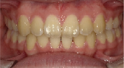 成人女性Aさん出っ歯(上顎前突)矯正治療14ヶ月目前