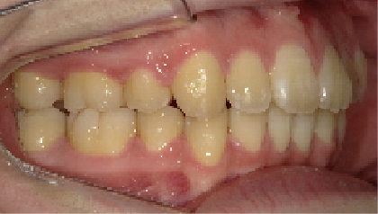 成人女性Aさん出っ歯(上顎前突)矯正治療14ヶ月目右