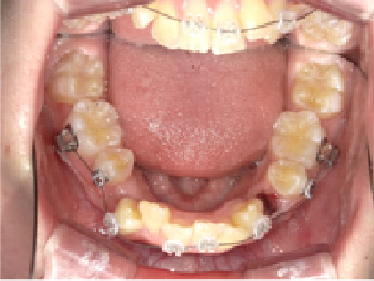 成人女性Aさん出っ歯(上顎前突)矯正治療初回下