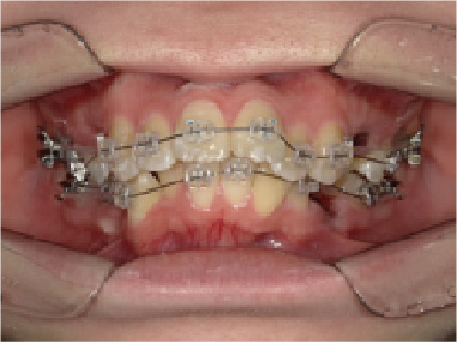 成人女性Aさん出っ歯(上顎前突)矯正治療初回前