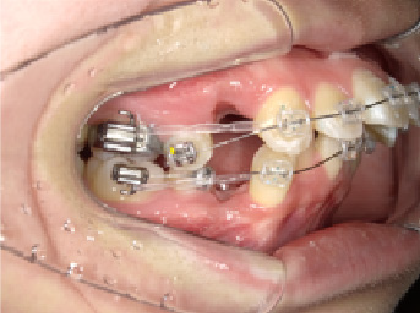 成人女性Aさん出っ歯(上顎前突)矯正治療初回右