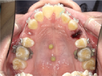 成人女性Aさん出っ歯(上顎前突)矯正治療初回上