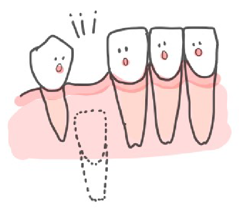 ６ヶ月以上永久歯が生えてこない場合のイラスト表現
