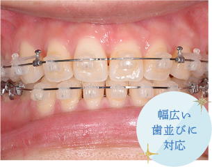 幅広い歯並びに対応