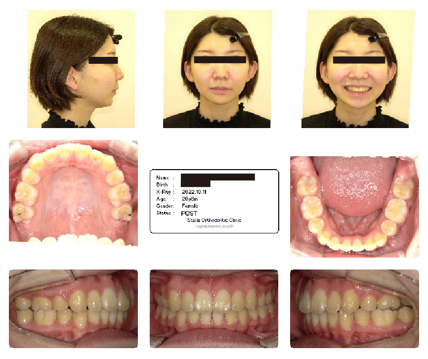 出っ歯矯正後の女性の口内写真
