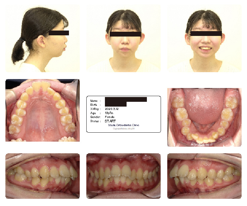 出っ歯の女性の口内写真