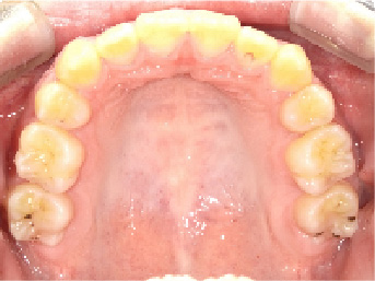 出っ歯矯正治療11ヶ月目上