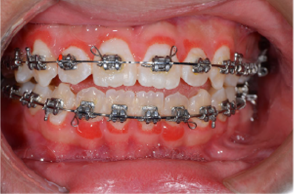 装置をつけた歯の周りの歯肉が赤く炎症している