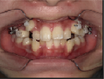 中学年生Aさん八重歯矯正治療3ヶ月目前