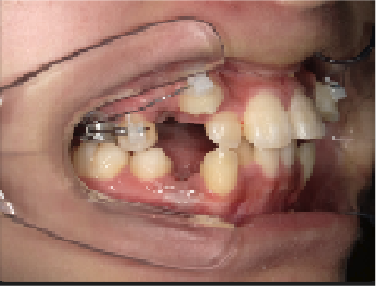 中学年生Aさん八重歯矯正治療3ヶ月目右