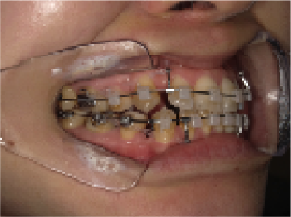 30代女性のBさん八重歯矯正治療7ヶ月目右